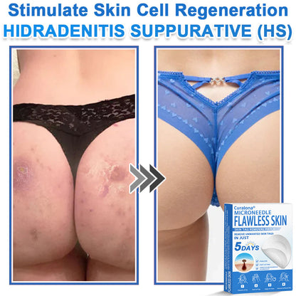 Curalona® 2-in-1 Microneedle & Hydrocolloid Patch | Raised Moles,Acne,  Flat Warts & Skin Tags Remover | Improves Wrinkles, Scars & Blemishes | Invisible Pimple Patches for Face & Body
