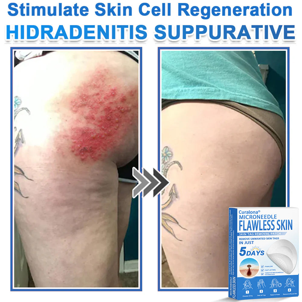 Curalona® 2-in-1 Microneedle & Hydrocolloid Patch | Raised Moles,Acne,  Flat Warts & Skin Tags Remover | Improves Wrinkles, Scars & Blemishes | Invisible Pimple Patches for Face & Body