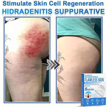 Curalona® 2-in-1 Microneedle & Hydrocolloid Patch | Raised Moles,Acne,  Flat Warts & Skin Tags Remover | Improves Wrinkles, Scars & Blemishes | Invisible Pimple Patches for Face & Body