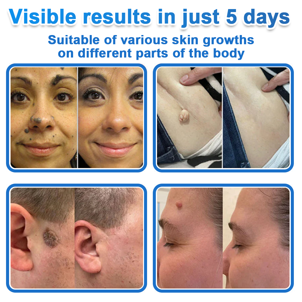 Curalona® 2-in-1 Microneedle & Hydrocolloid Patch | Raised Moles,Acne,  Flat Warts & Skin Tags Remover | Improves Wrinkles, Scars & Blemishes | Invisible Pimple Patches for Face & Body