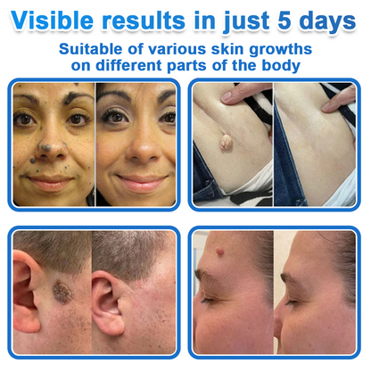 Curalona® 2-in-1 Microneedle & Hydrocolloid Patch | Raised Moles,Acne,  Flat Warts & Skin Tags Remover | Improves Wrinkles, Scars & Blemishes | Invisible Pimple Patches for Face & Body