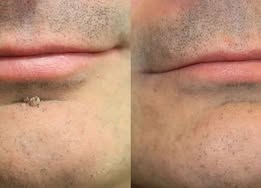 ✨Curalona®2-in-1 Microneedle & Hydrocolloid Patch🍀| Removes Raised Moles, Acne, Flat Warts & Skin Tags | Helps Improve Wrinkles, Scars & Blemishes | Invisible Patches for Face & Body